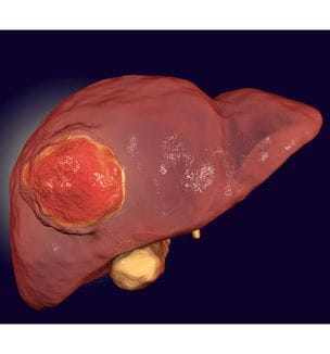 Liver cancer illustration