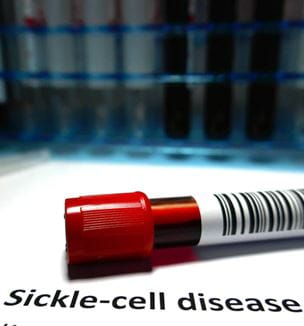 Sickle cell disease illustration