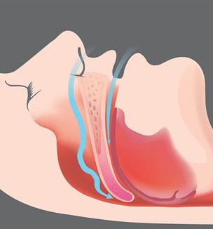 Obstructive sleep apnea illustration
