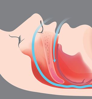 Sleep apnea illustration