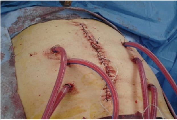 HIPEC intraoperative set-up a the time of interval debulking for advanced ovarian cancer