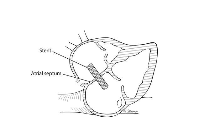 Schematic demonstrating the technique used to place a stent in utero in the setting of hypoplastic left heart syndrome with intact atrial septum.