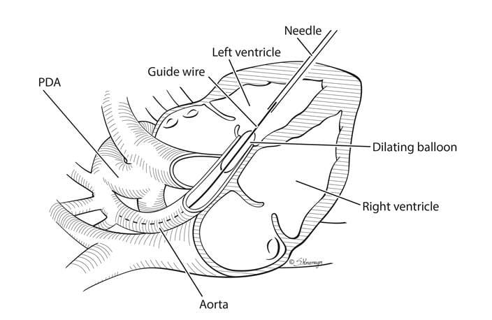 Schematic demonstrating the technique used to open the aortic valve in utero in the setting of severe aortic stenosis and impending HLHS.