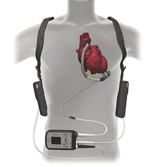 LVAD device illustration on patient