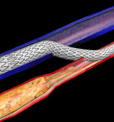 University Hospitals Research Published in NEJM Shows Minimally Invasive Procedure Saves Most Patients with Severe Vascular Disease from Amputation