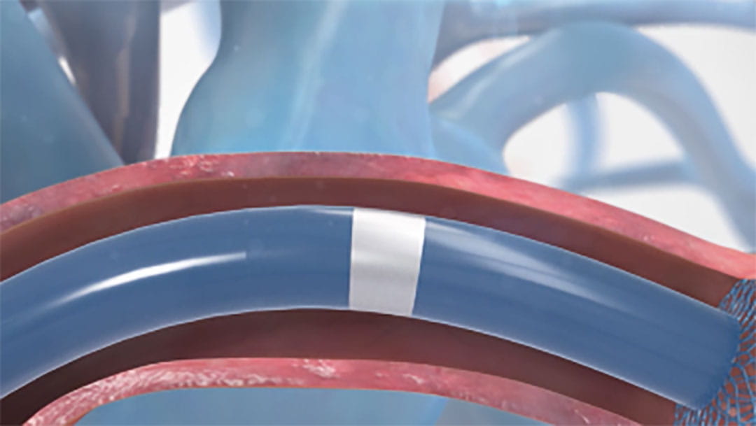 Martin Bocks MD Discusses use of Piccolo Occluder Device to Repair