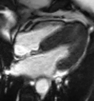 MRI iamge of cardiomyopathy