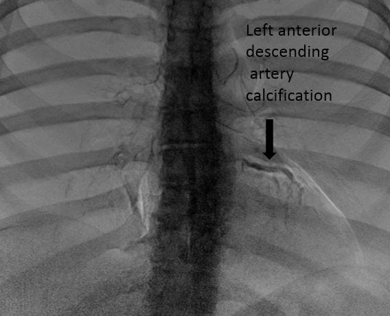 Left descending artery calcification