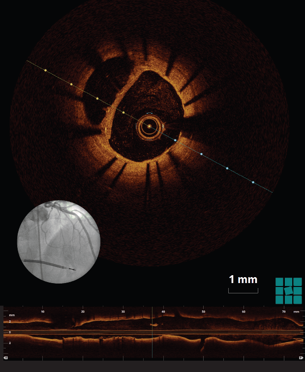 Image of Optical coherence tomography