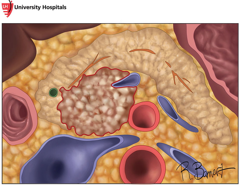 Medical illustration of cancer of the pancreas