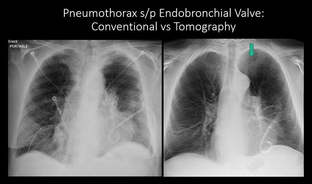 Pneumothorax s/p Endobronchial Valve: Conventional vs tomography