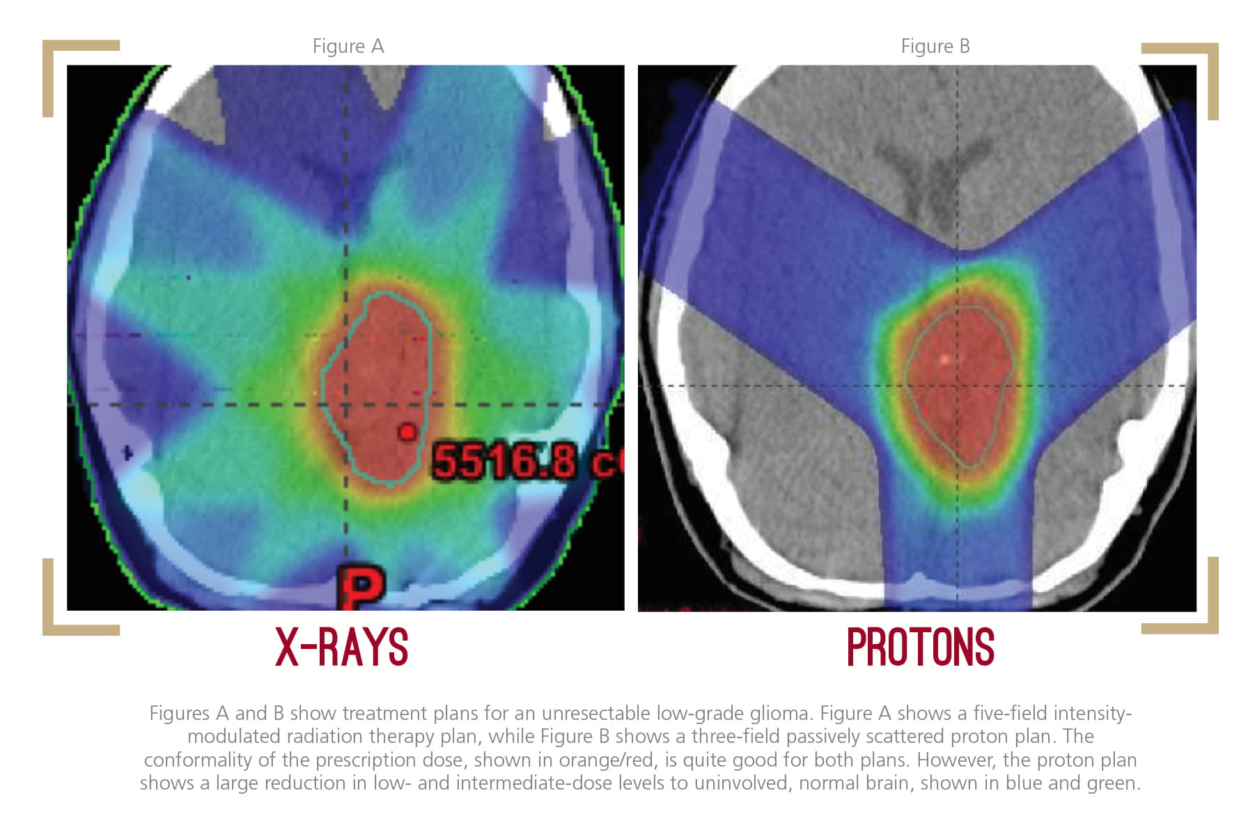 Illustration: X-rays versus Proton Therapy