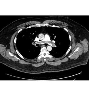 Pulmonary Embolism scan