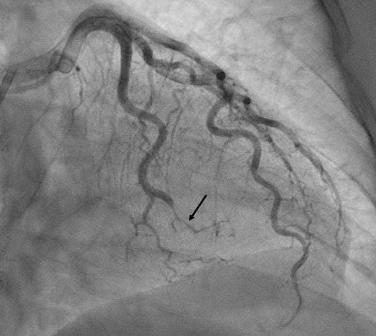 Spontaneous coronary artery dissection (SCAD) of an obtuse marginal artery (arrow) in a 62-year-old woman with non ST-segment elevation myocardial infarction. She was managed with medical therapy.  She was subsequently found to have FMD in multiple arteries and evidence of a prior silent vertebral artery dissection. Note is made of tortuosity of the coronary arteries, a finding that has been associated with SCAD.