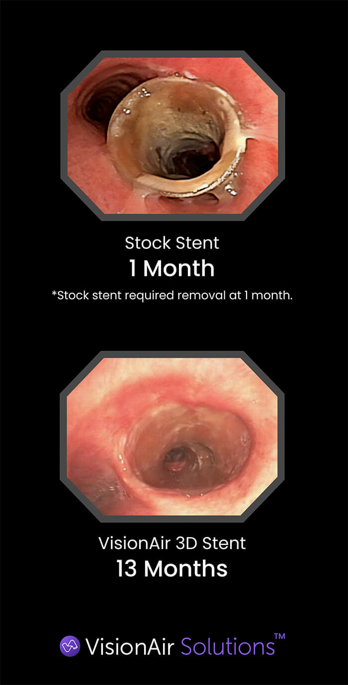 Pulmonology 3d stent comparison image