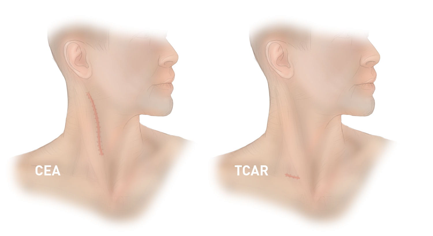 CEA vs. TCAR scar.