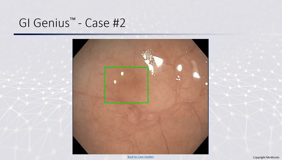 A sessile serrated adenoma (highlighted by green box) that was picked up by the AI module but not seen by the endoscopist