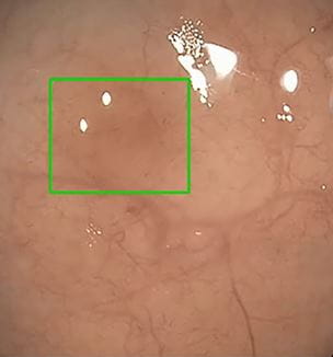 A sessile serrated adenoma (highlighted by green box) that was picked up by the AI module but not seen by the endoscopist