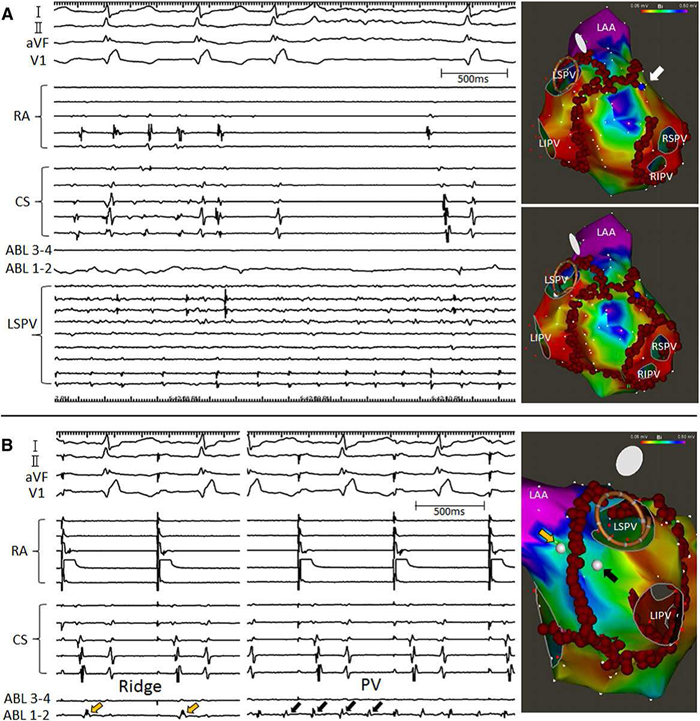 Voltage Mapping and AF Ablation Strategy