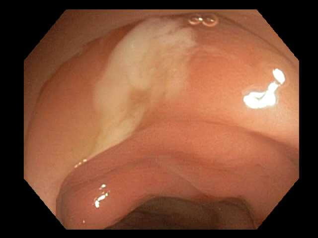 Image of pouches that form in the colon wall typical of diverticulosis