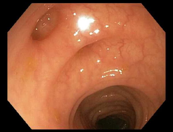 Image of pus in the inflamed segment of bowel is typical of diverticulitis