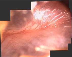 Digital image of normal appearing tympanic membrane.