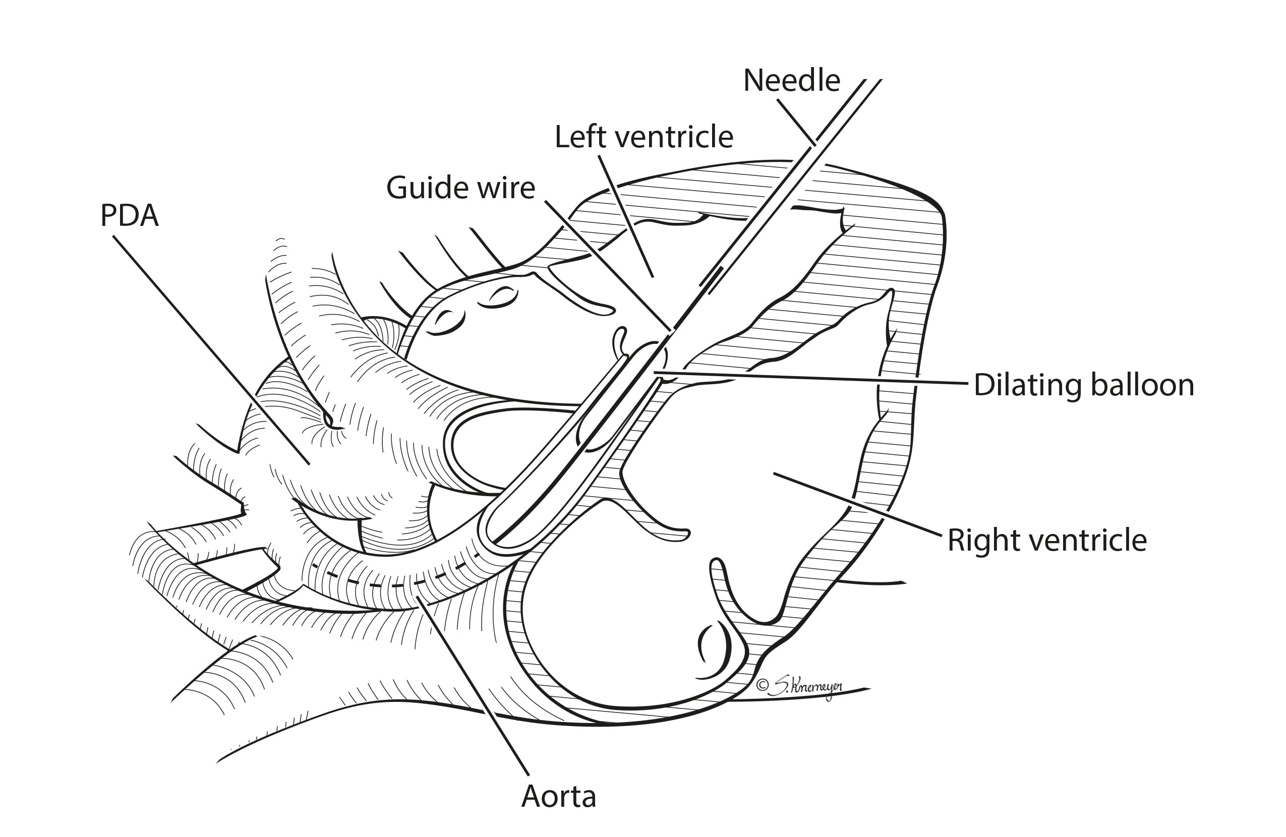 Fetal cardia intervention aortic stenosis illustration
