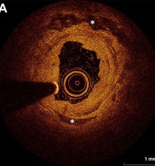 Example of intravascular imaging via (A) optical coherence tomography, published J Am Coll Cardiol Intv. Jan 17, 2024. Epublished DOI: 10.1016/j.jcin.2023.11.040