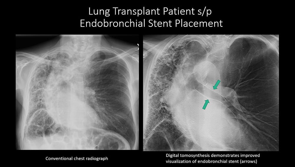 Lungs transplant patient s/p Endobronchial stent placement