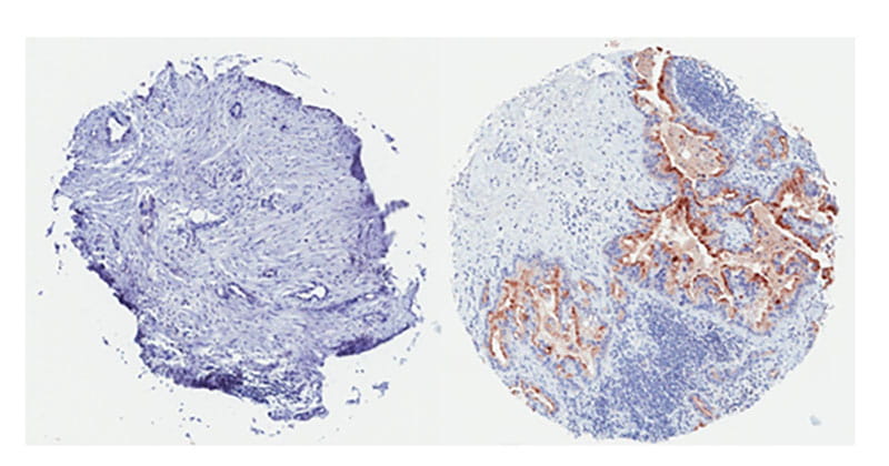 pancreatic tumor is mesothelin-negative. (Right) This pancreatic tumor is widely positive for mesothelin expression and it is expected would respond well to mesothelin-directed CAR-T cell therapy