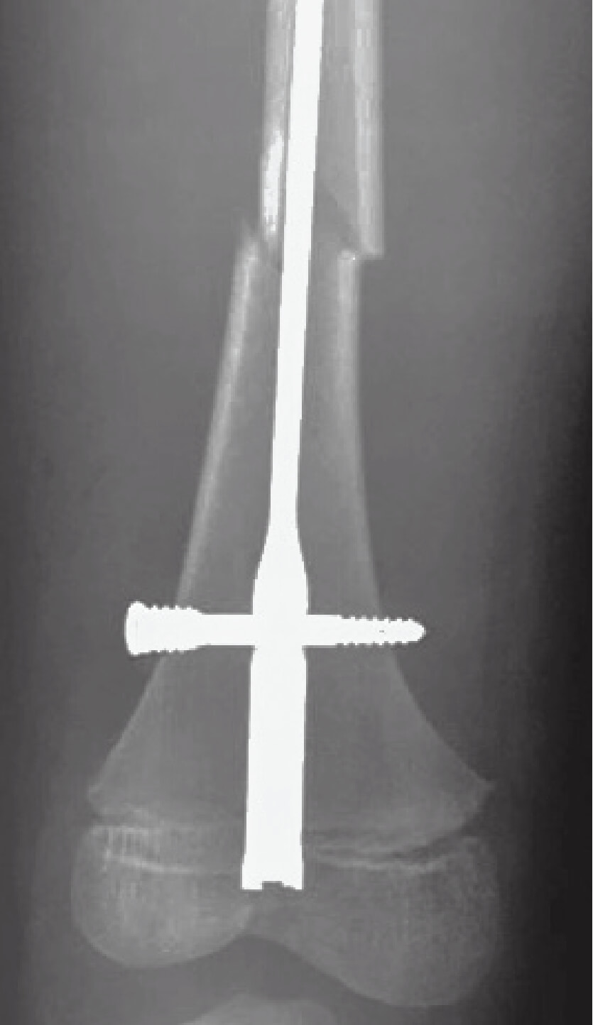 Ortho fracture repair figure 1A
