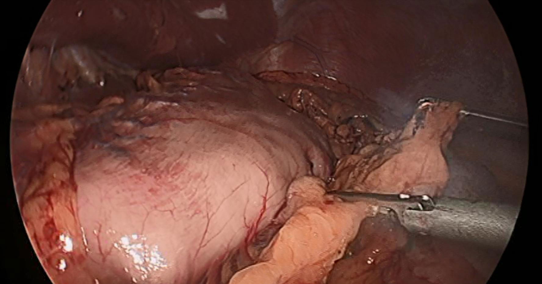 Laparoscopic view of the stomach