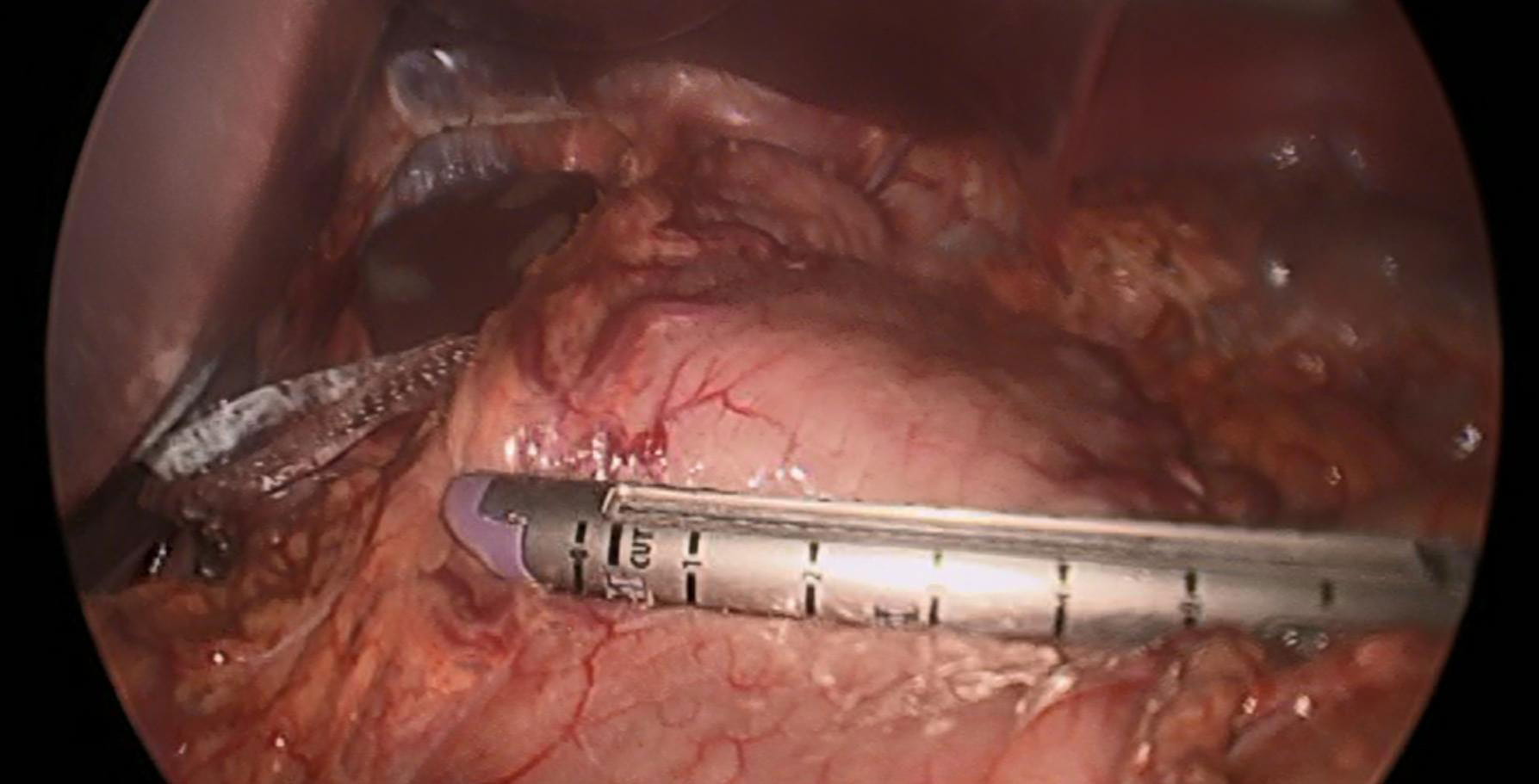 Laparoscopic view of a surgical stapler on the stomach