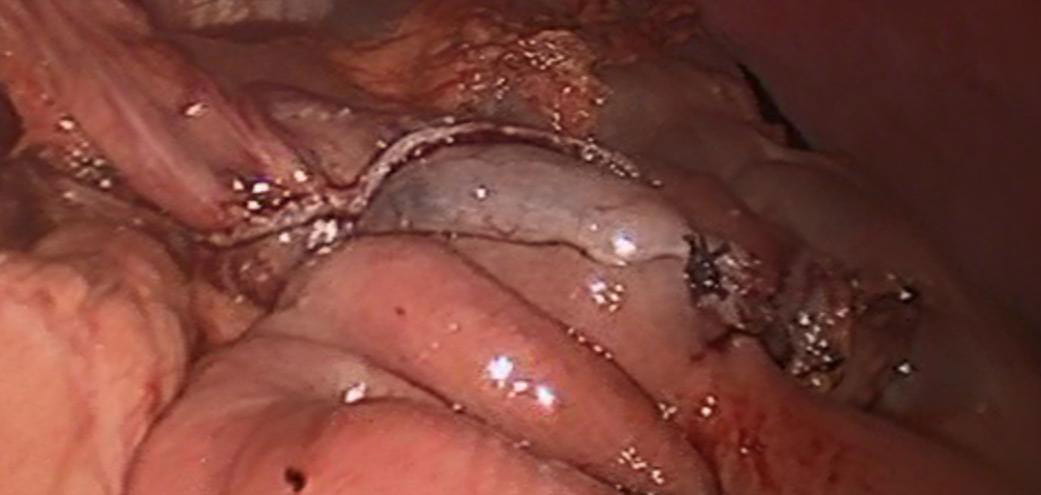 Laparoscopic view of the completed gastrojejunal anastomosis after distal gastrectomy