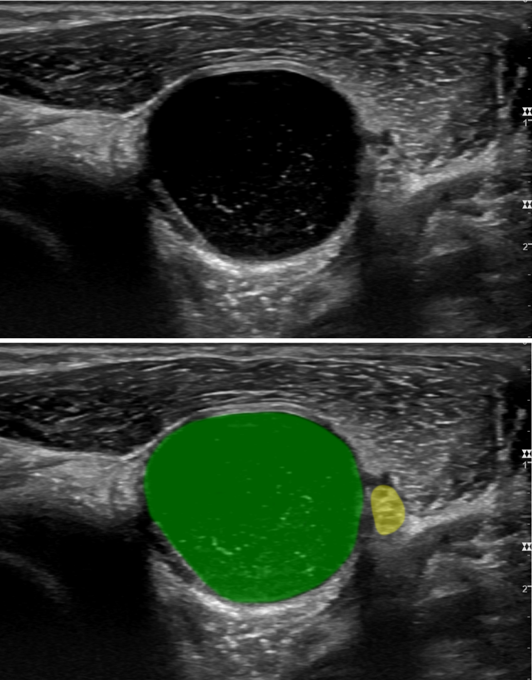 Image Caption: A large ganglion cyst (green) is displacing the radial nerve (yellow)  near the elbow.
