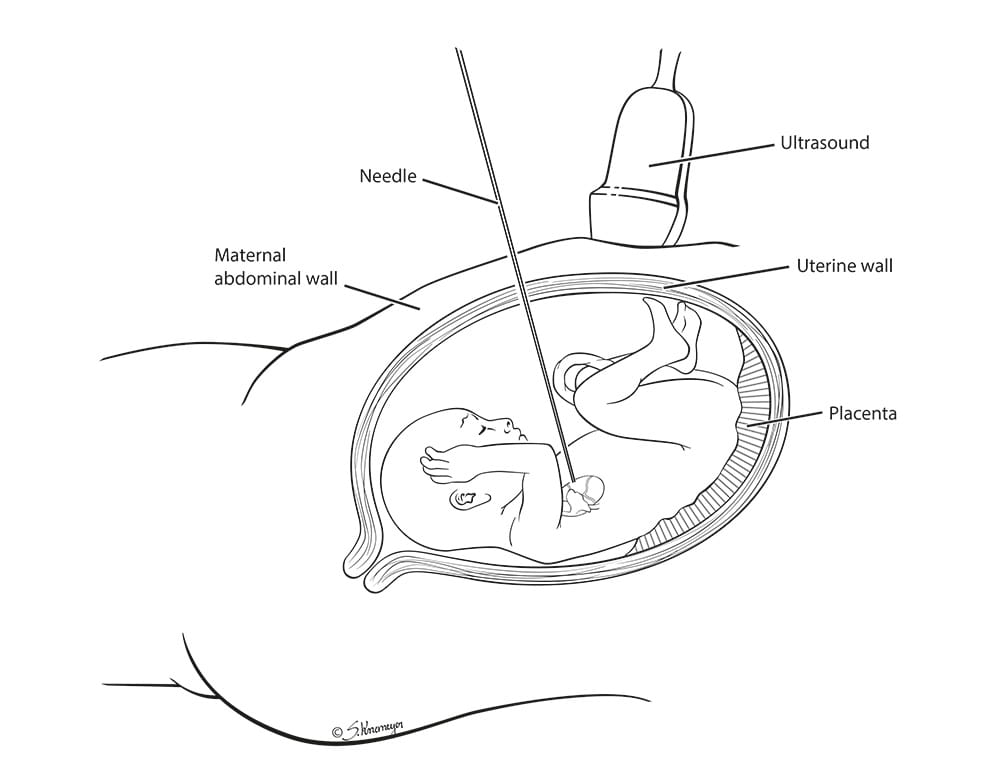 Fetal cardiac intervention overview image