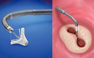 Side by side illustration of the MitraClip procedure