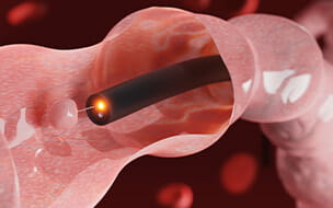3D rendering of an endoscope inside colonoscopy showing colon polyp removal