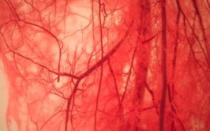 Vascular Conditions