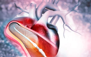 Heart Attack and Stents