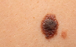 Skin Cancer Awareness: From Prevention to Action