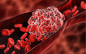 Deep vein thrombosis illustration