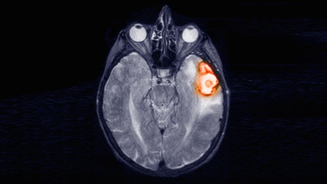 Temporoparietal brain hemorrhage shown on an MRI scan