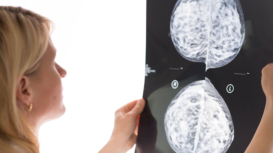 female doctor examining a mammogram result on medical monitor