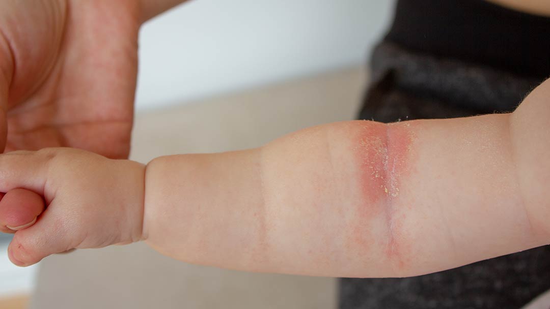 baby arm with dermatitis