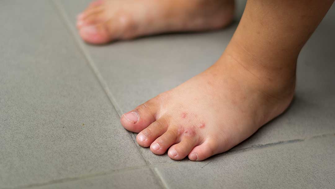 baby feet with red rash