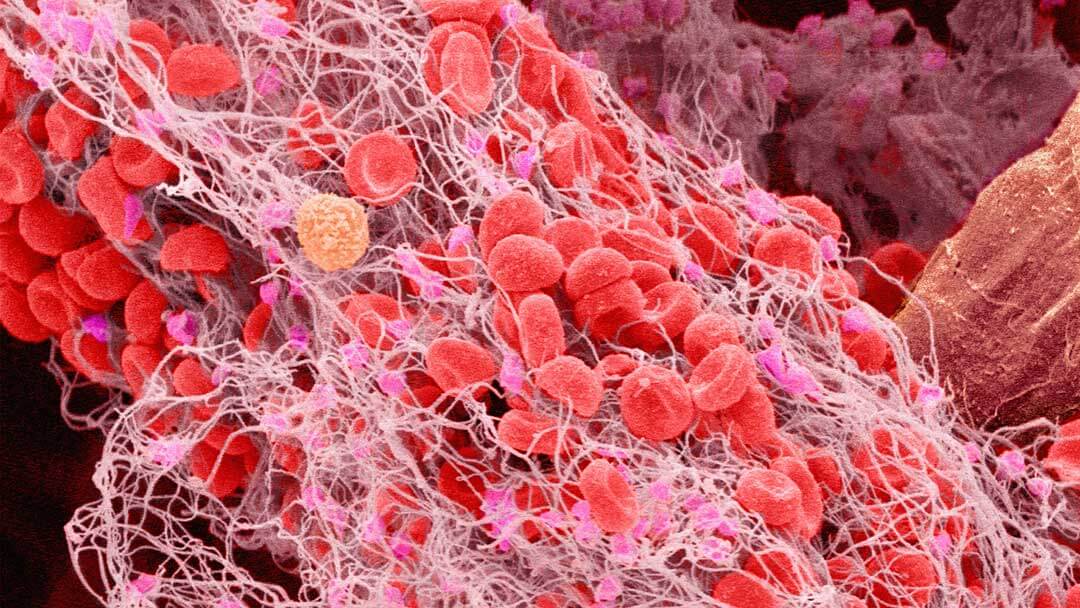 Blood Clot Clinical Study University Hospital Research & Innovation