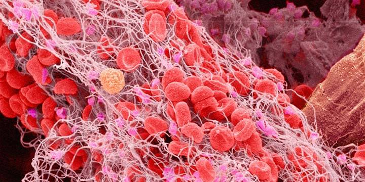 Scanning electron micrograph of a blood clot in human blood