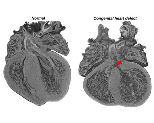 heart scans