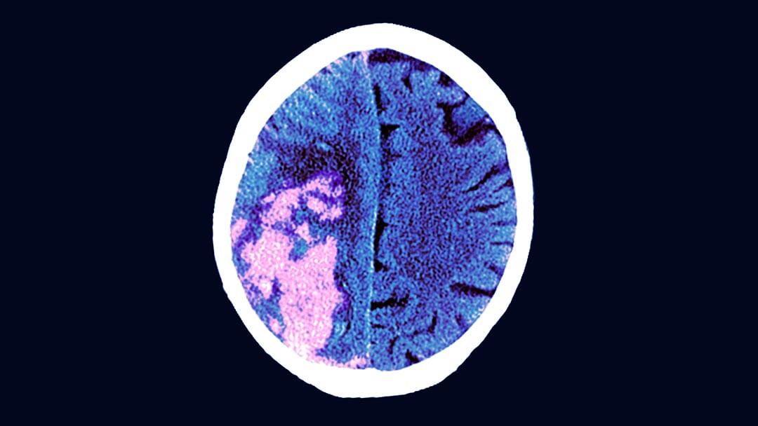 Brain in stroke
